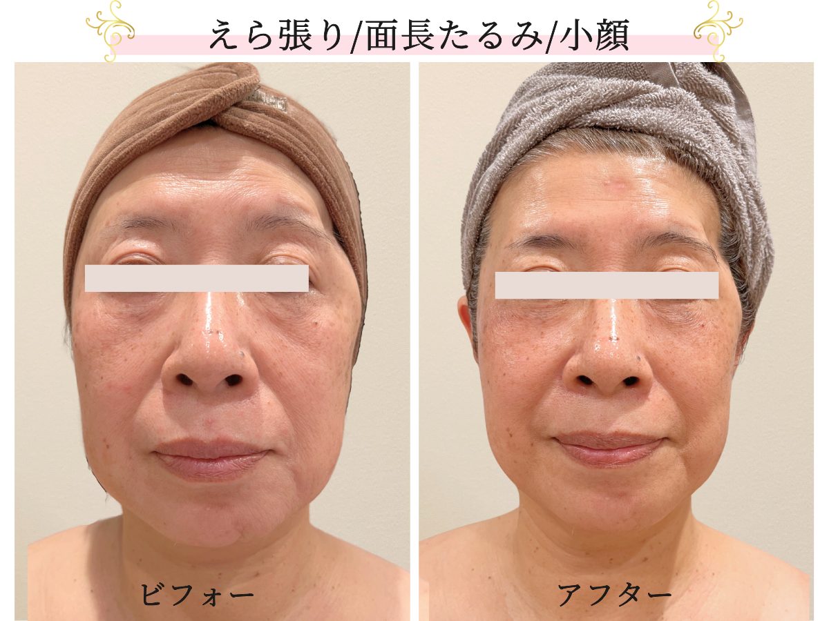 天神で小顔整体を体感 本当に変われる矯正の真実